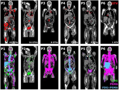 Frontiers | Combined Biology-guided Radiotherapy And Lutetium PSMA ...